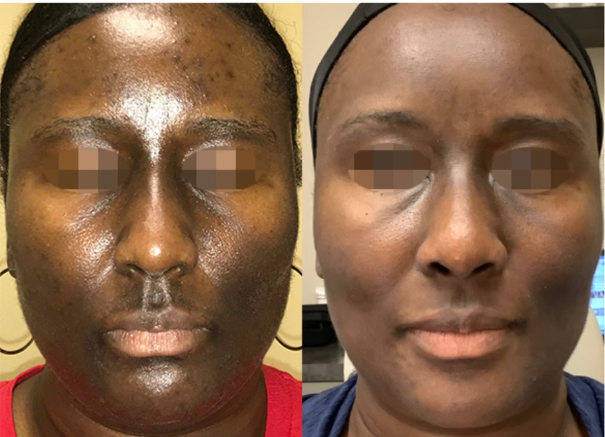 Before and after ClearLift laser — result 1 at Majspa, Marietta GA