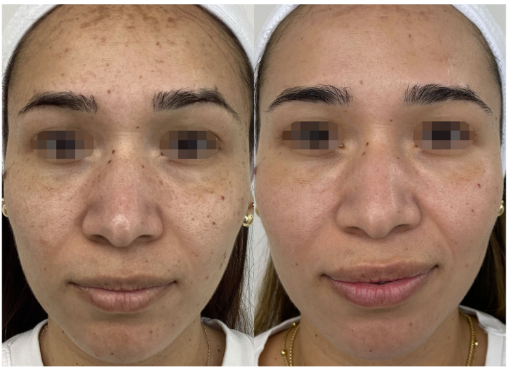 Before and after ClearLift laser — result 2 at Majspa, Marietta GA