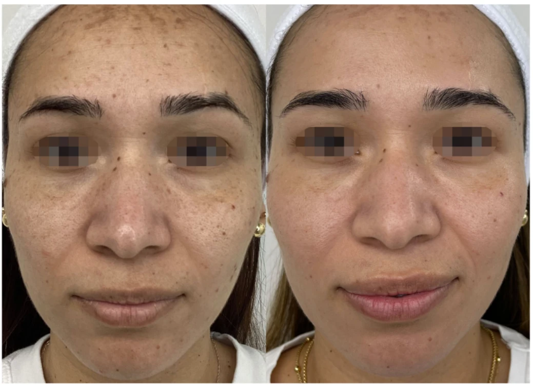Before and after ClearLift laser — result 2 at Majspa, Marietta GA