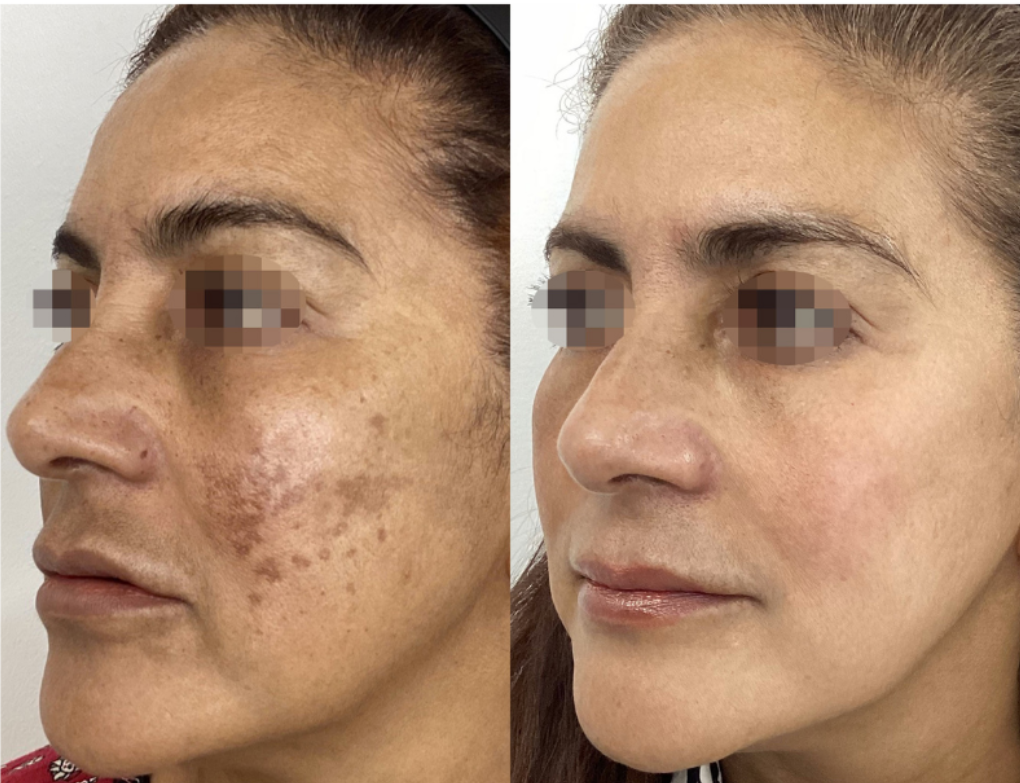 Before and after ClearLift laser — result 3 at Majspa, Marietta GA