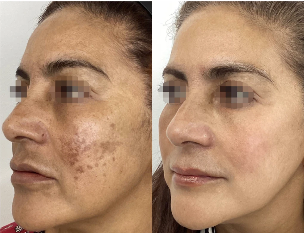 Before and after ClearLift laser — result 3 at Majspa, Marietta GA