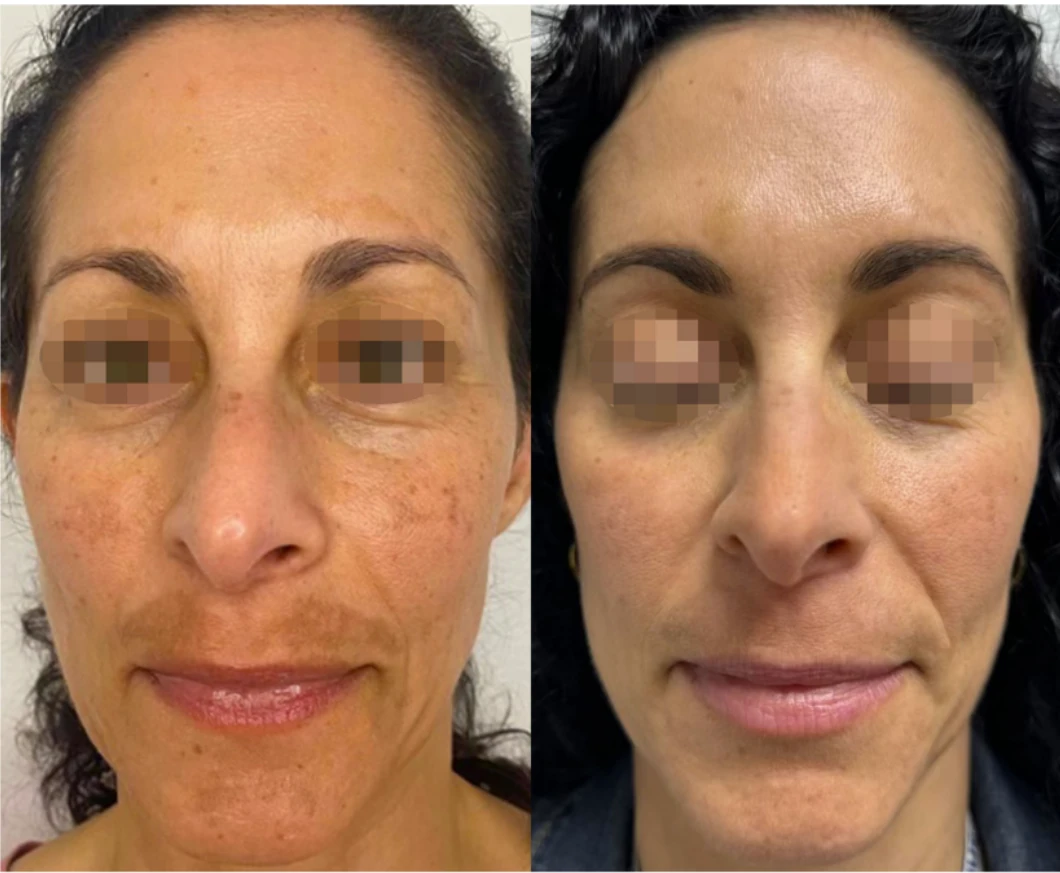 Before and after ClearLift laser — result 4 at Majspa, Marietta GA