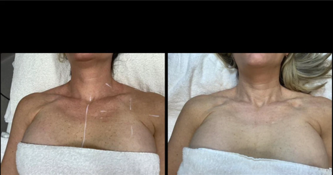 Before and after IPL photofacial — result 1 at Majspa, Marietta GA