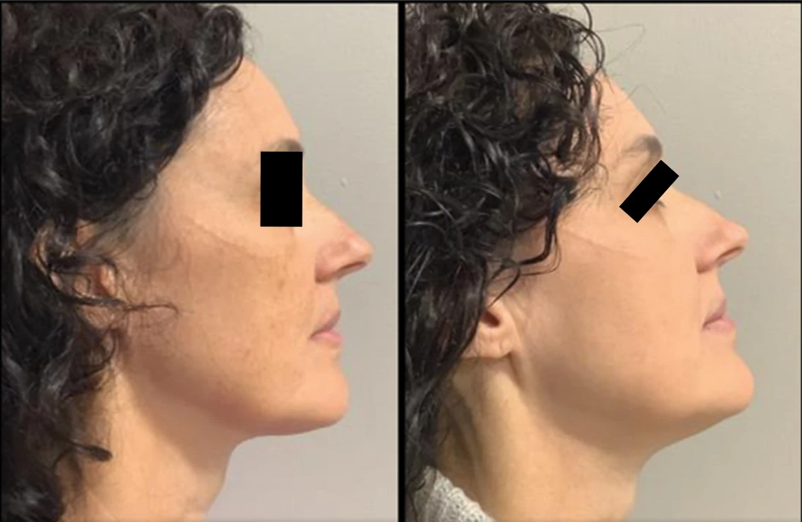 Before and after IPL photofacial — result 2 at Majspa, Marietta GA