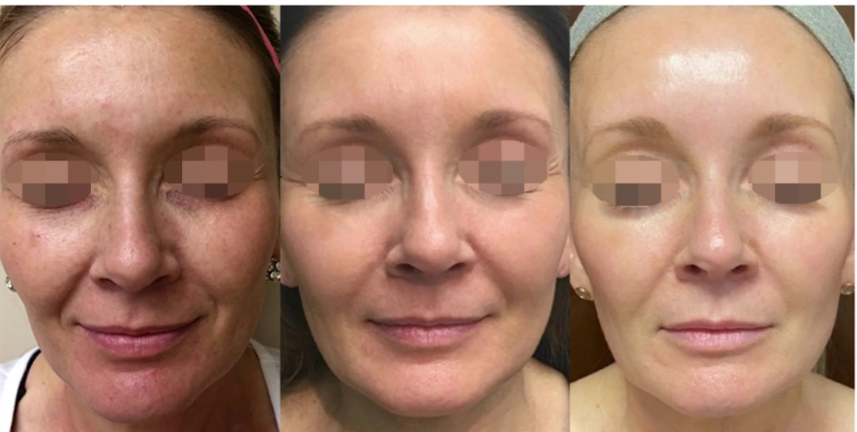 Before and after IPL photofacial — result 3 at Majspa, Marietta GA