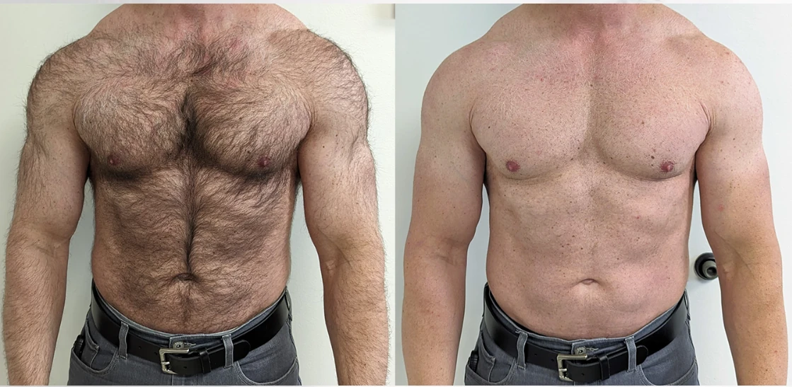 Before and after laser hair removal — result 1 at Majspa, Marietta GA