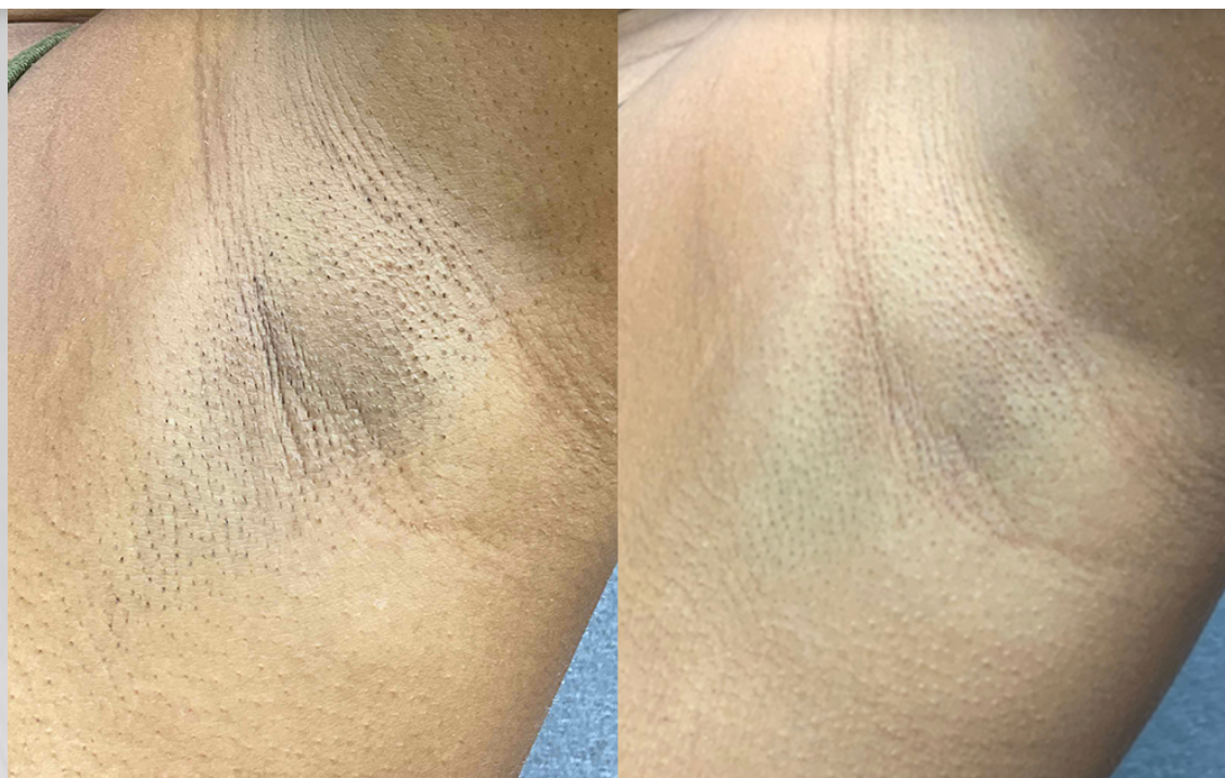 Before and after laser hair removal — result 2 at Majspa, Marietta GA