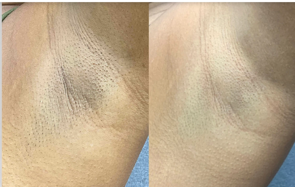 Before and after laser hair removal — result 2 at Majspa, Marietta GA