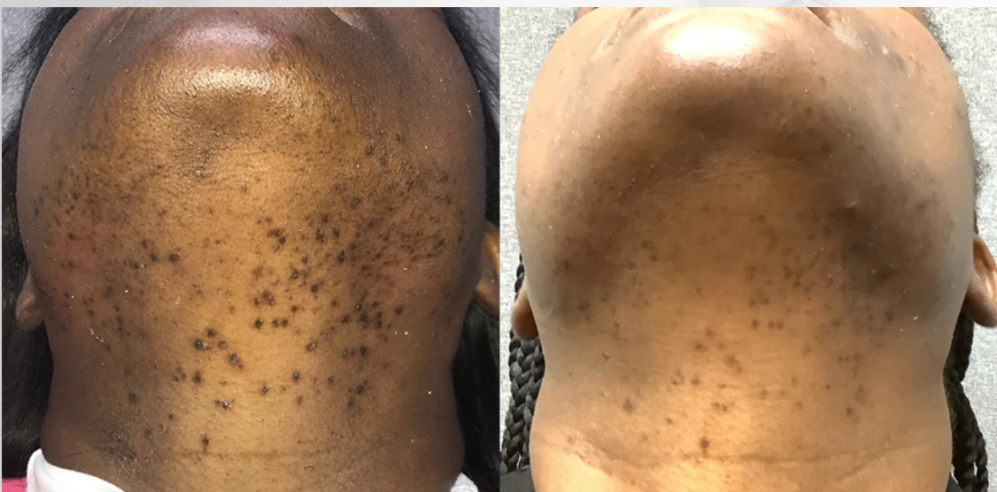 Before and after laser hair removal — result 3 at Majspa, Marietta GA