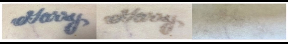 Before and after laser tattoo removal — result 1 at Majspa, Marietta GA