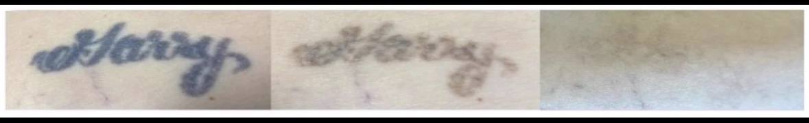 Before and after laser tattoo removal — result 1 at Majspa, Marietta GA