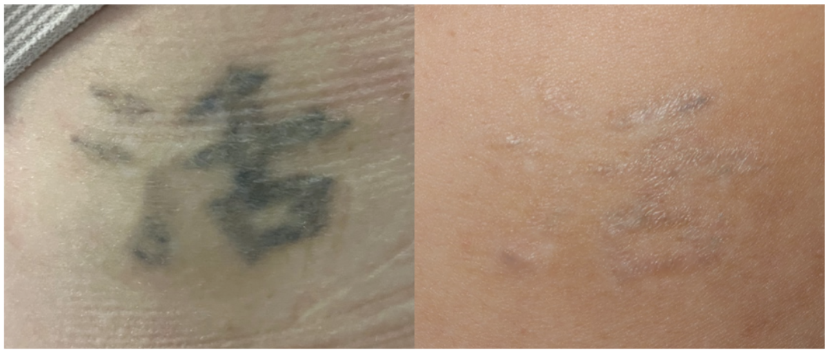 Before and after laser tattoo removal — result 2 at Majspa, Marietta GA