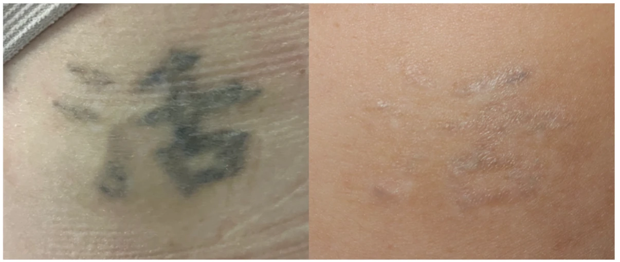 Before and after laser tattoo removal — result 2 at Majspa, Marietta GA